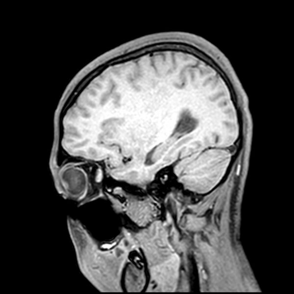File:Central neurocytoma (Radiopaedia 79320-92380 Sagittal T1 77).jpg