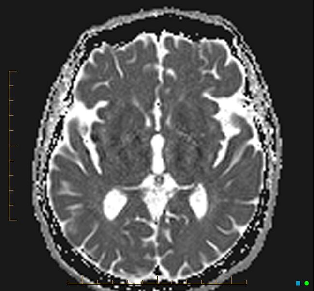 File:Cerebellar gangliocytoma (Radiopaedia 65377-74422 Axial ADC 19).jpg