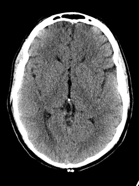 File:Cerebellar infarct due to vertebral artery dissection with posterior fossa decompression (Radiopaedia 82779-97032 Axial non-contrast 14).png