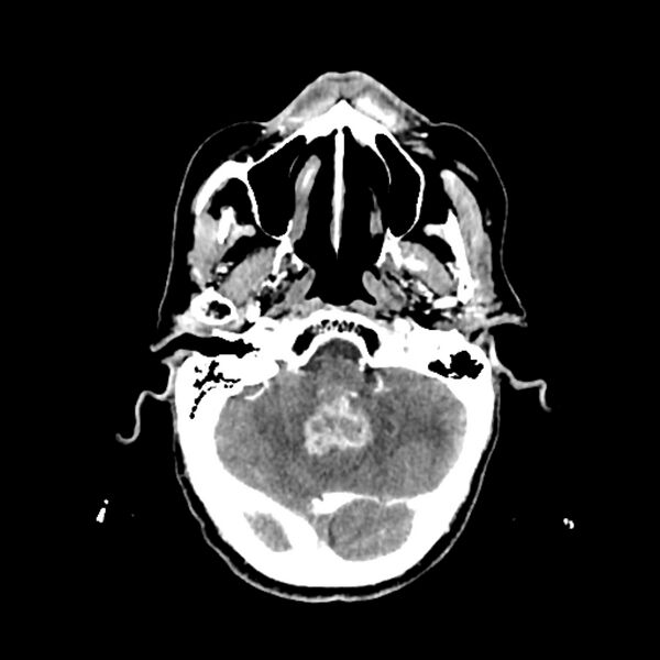 File:Cerebellar metastasis - lung tumor (Radiopaedia 69317-79145 Axial with contrast 9).jpg