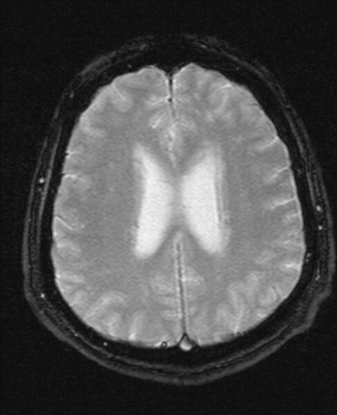 File:Cerebellopontine angle meningioma (Radiopaedia 24459-24764 Axial Gradient Echo 16).jpg