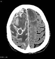Cerebral abscesses secondary to contusions (Radiopaedia 5201-6967 Axial C+ delayed 8).jpg