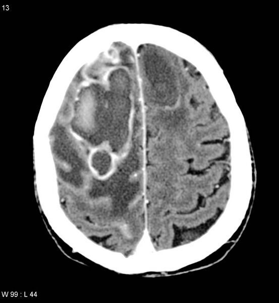 File:Cerebral abscesses secondary to contusions (Radiopaedia 5201-6967 Axial C+ delayed 8).jpg