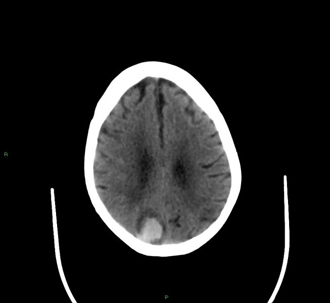 File:Cerebral amyloid angiopathy-associated lobar intracerebral hemorrhage (Radiopaedia 58377-65514 Axial non-contrast 16).jpg