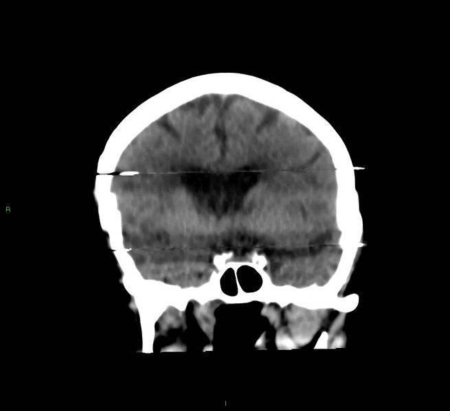 File:Cerebral amyloid angiopathy-associated lobar intracerebral hemorrhage (Radiopaedia 58377-65514 Coronal non-contrast 40).jpg