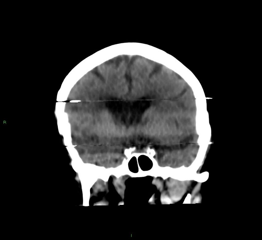 Cerebral amyloid angiopathy-associated lobar intracerebral hemorrhage (Radiopaedia 58377-65514 Coronal non-contrast 40).jpg