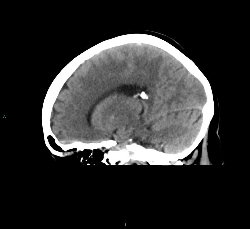 Cerebral amyloid angiopathy-associated lobar intracerebral hemorrhage (Radiopaedia 58378-65516 C 21).jpg