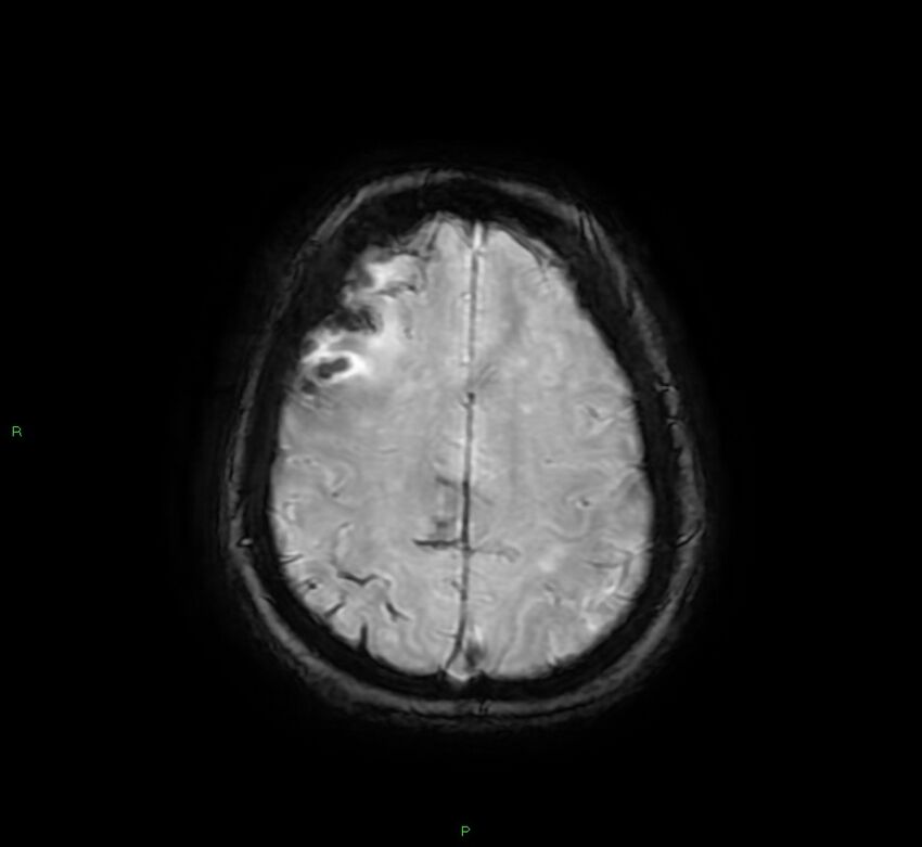 Cerebral amyloid angiopathy-associated lobar intracerebral hemorrhage (Radiopaedia 58378-65517 Axial SWI 58).jpg