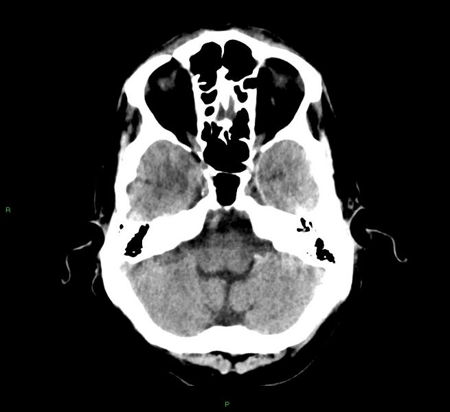 File:Cerebral amyloid angiopathy-associated lobar intracerebral hemorrhage (Radiopaedia 58529-65687 Axial non-contrast 40).jpg