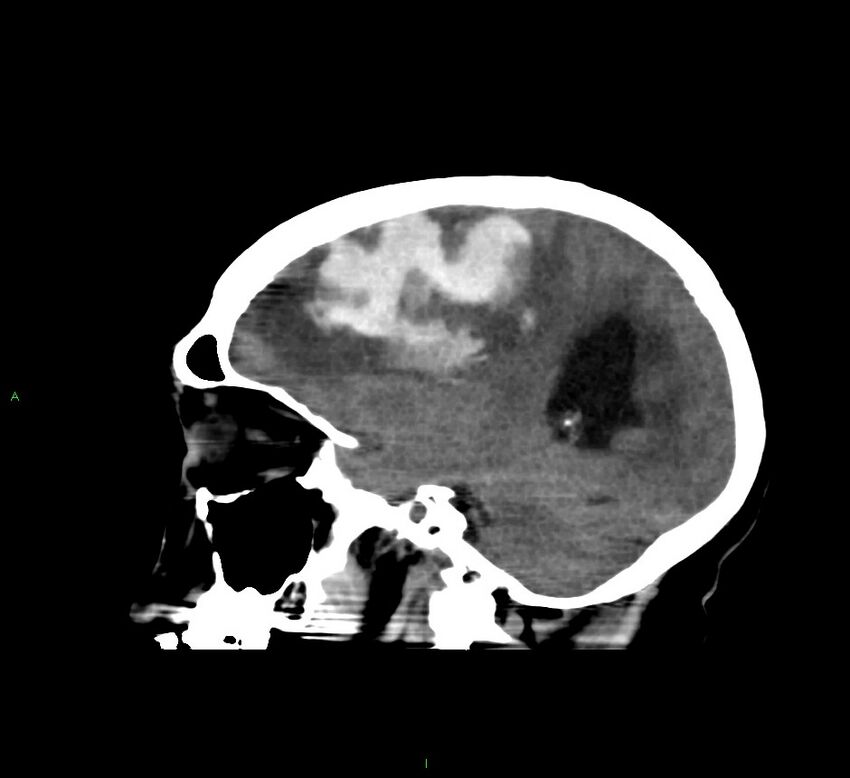 Cerebral amyloid angiopathy-associated lobar intracerebral hemorrhage (Radiopaedia 58560-65723 C 18).jpg
