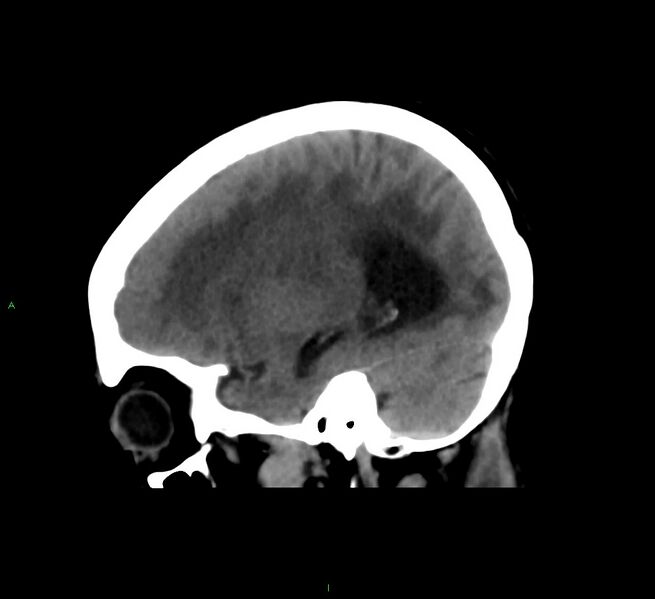 File:Cerebral amyloid angiopathy-associated lobar intracerebral hemorrhage (Radiopaedia 58561-65724 C 15).jpg