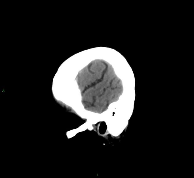 File:Cerebral amyloid angiopathy-associated lobar intracerebral hemorrhage (Radiopaedia 58561-65724 C 6).jpg