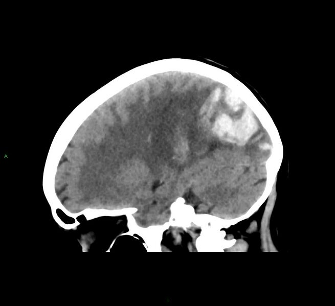 File:Cerebral amyloid angiopathy-associated lobar intracerebral hemorrhage (Radiopaedia 58563-65727 C 21).jpg
