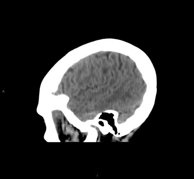 File:Cerebral amyloid angiopathy-associated lobar intracerebral hemorrhage (Radiopaedia 58566-65730 C 42).jpg