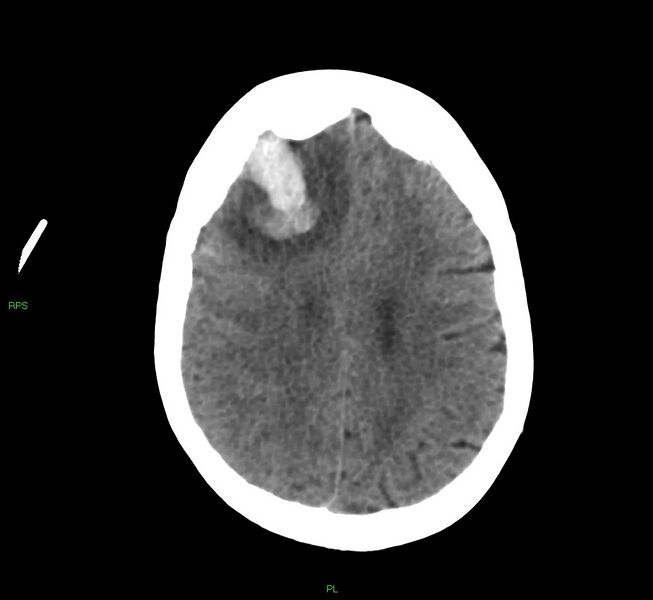 File:Cerebral amyloid angiopathy-associated lobar intracerebral hemorrhage (Radiopaedia 58569-65734 Axial non-contrast 24).jpg