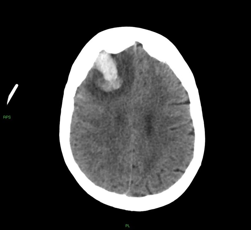 Cerebral amyloid angiopathy-associated lobar intracerebral hemorrhage (Radiopaedia 58569-65734 Axial non-contrast 24).jpg