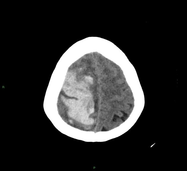 File:Cerebral amyloid angiopathy-associated lobar intracerebral hemorrhage (Radiopaedia 58751-65972 Axial non-contrast 11).jpg