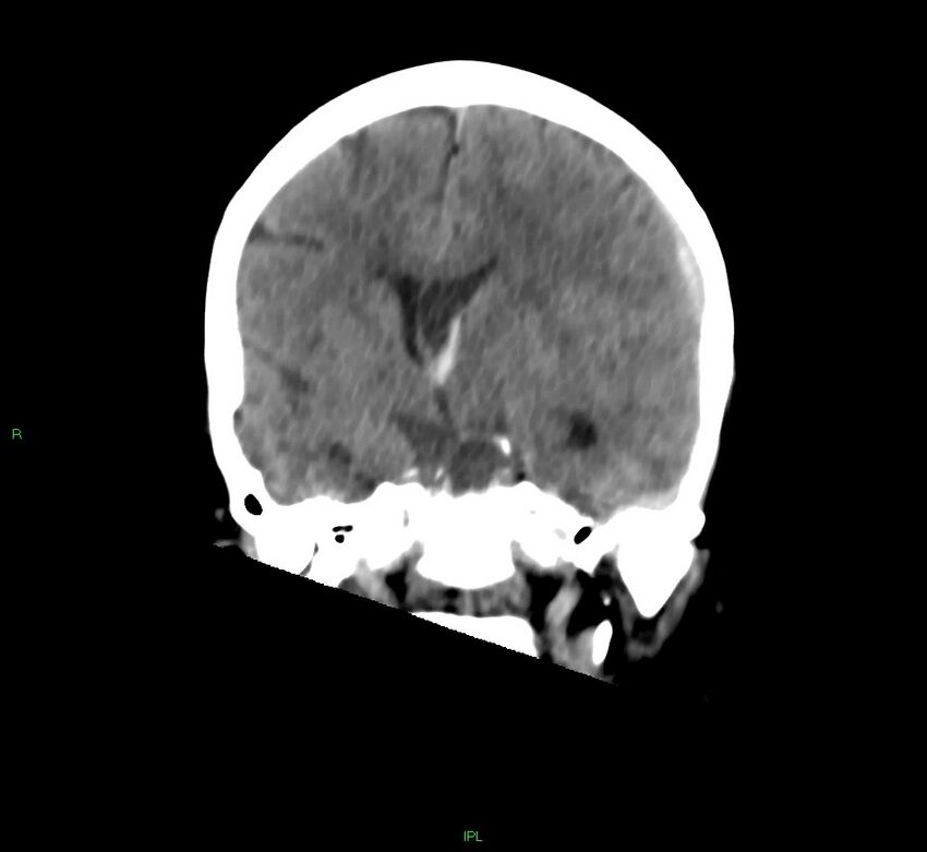 Cerebral amyloid angiopathy-associated lobar intracerebral hemorrhage (Radiopaedia 58754-65975 Coronal non-contrast 36).jpg