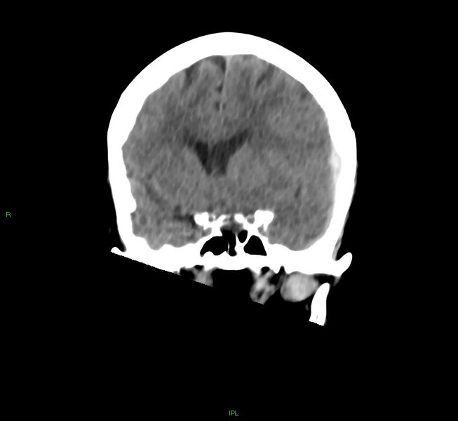 File:Cerebral amyloid angiopathy-associated lobar intracerebral hemorrhage (Radiopaedia 58754-65975 Coronal non-contrast 40).jpg