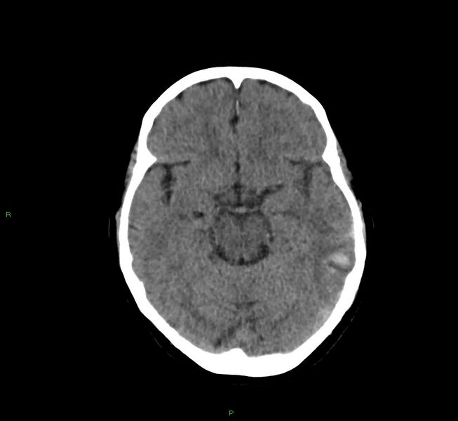 File:Cerebral amyloid angiopathy-associated lobar intracerebral hemorrhage (Radiopaedia 58757-65978 Axial non-contrast 33).jpg