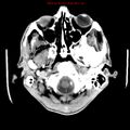 Cerebral and orbital tuberculomas (Radiopaedia 13308-13310 B 4).jpg