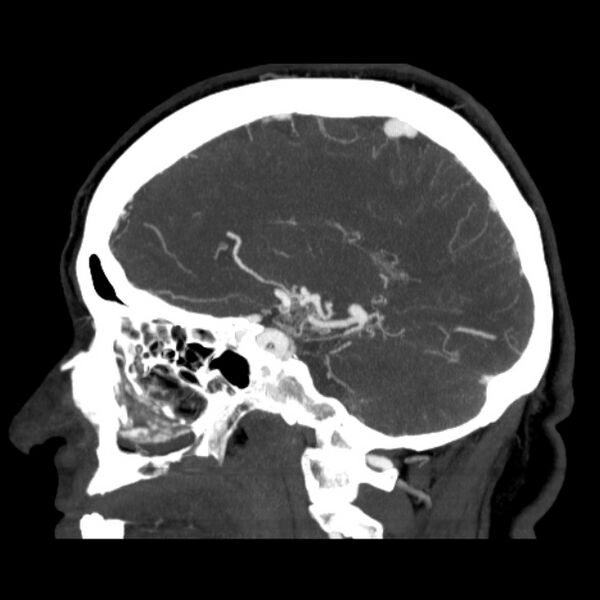 File:Cerebral arteriovenous malformation (Radiopaedia 43729-47189 D 30).jpg