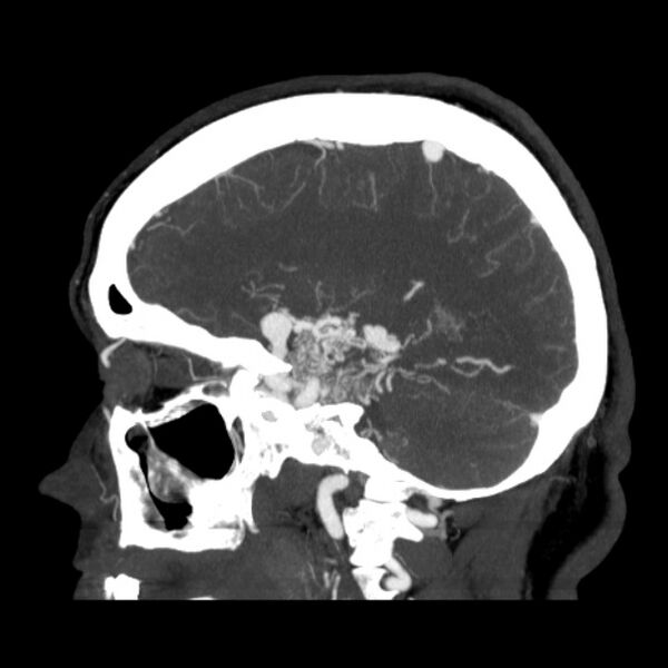 File:Cerebral arteriovenous malformation (Radiopaedia 43729-47189 D 33).jpg