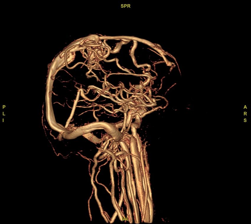 Cerebral arteriovenous malformation (Radiopaedia 61964-70029 VRT 25).jpg