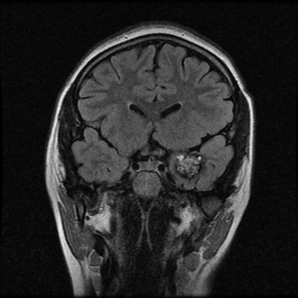 File:Cerebral cavernous malformation (Radiopaedia 44301-47942 Coronal FLAIR 6).jpg