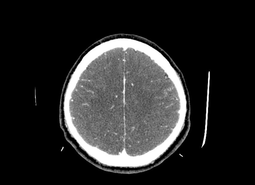 Cerebral edema (Radiopaedia 82519-96661 B 18).jpg
