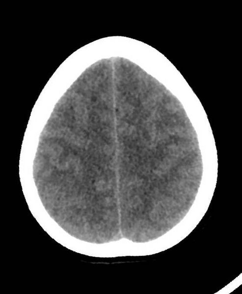 File:Cerebral edema due to severe hyponatremia (Radiopaedia 89826-106937 Axial non-contrast 74).jpg