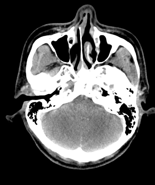 File:Cervical abscess (Radiopaedia 43725-47184 A 4).png