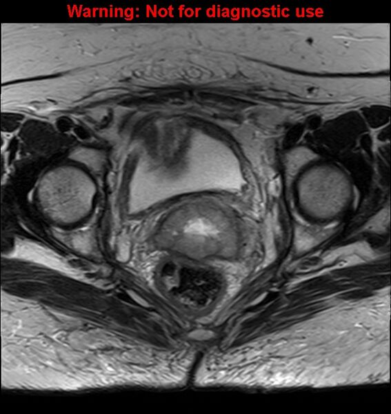 File:Cervical cancer (Radiopaedia 24151-24410 Axial T2 20).jpg