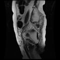 Cervical carcinoma (Radiopaedia 78847-91705 Sagittal T2 15).jpg