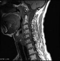 Cervical disc extrusion (Radiopaedia 5216-6982 Sagittal T1 1).jpg