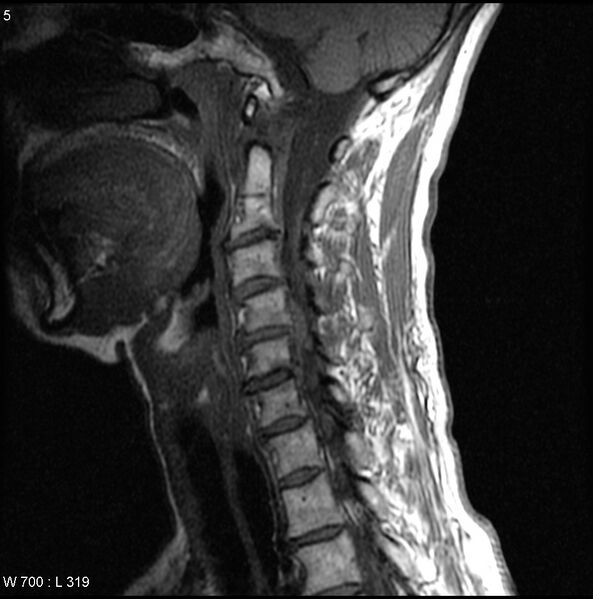 File:Cervical disc extrusion (Radiopaedia 5216-6982 Sagittal T1 1).jpg