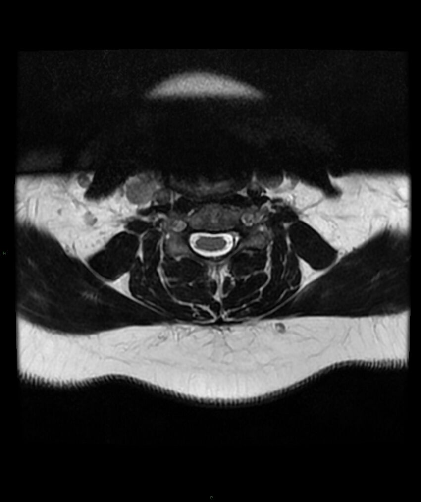 Cervical disc prolapse (Radiopaedia 80258-93598 Axial T2 31).jpg