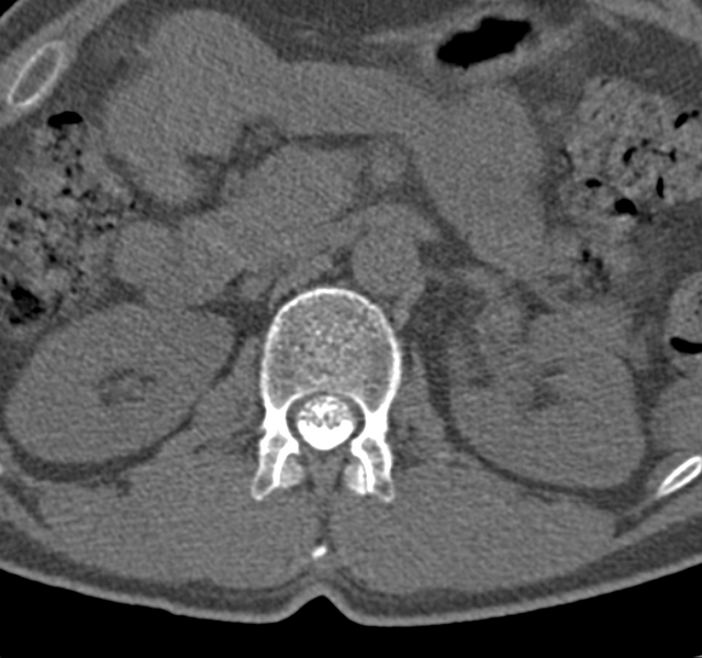 File:Cervical dural CSF leak on MRI and CT treated by blood patch (Radiopaedia 49748-54996 B 89).png