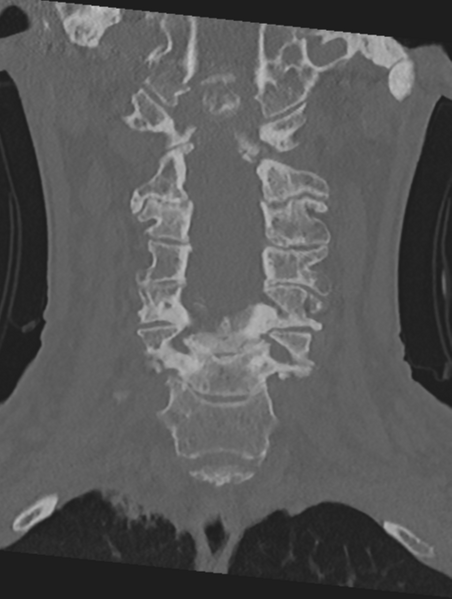 File:Cervical spondylolysis (Radiopaedia 49616-54811 Coronal bone window 22).png