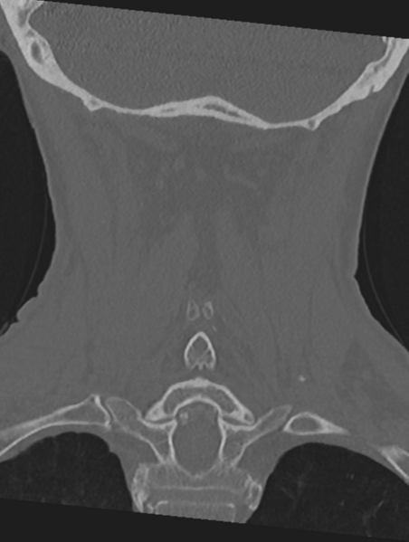 File:Cervical spondylolysis (Radiopaedia 49616-54811 Coronal bone window 42).png
