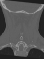 Cervical spondylolysis (Radiopaedia 49616-54811 Coronal bone window 42).png