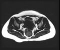 Cesarean section scar endometrioma (Radiopaedia 56569-63297 Axial T1 1).jpg