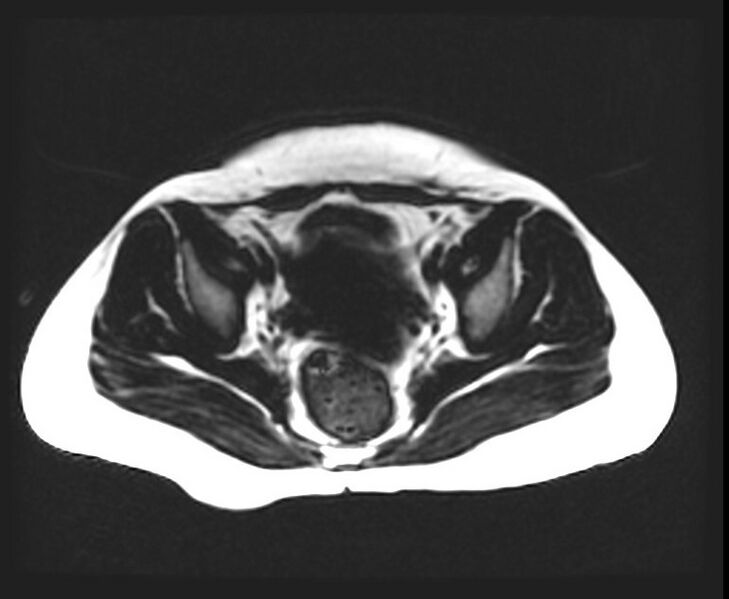 File:Cesarean section scar endometrioma (Radiopaedia 56569-63297 Axial T1 1).jpg