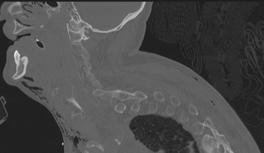 Chalk stick fracture (Radiopaedia 57948-64928 Sagittal bone window 46).png