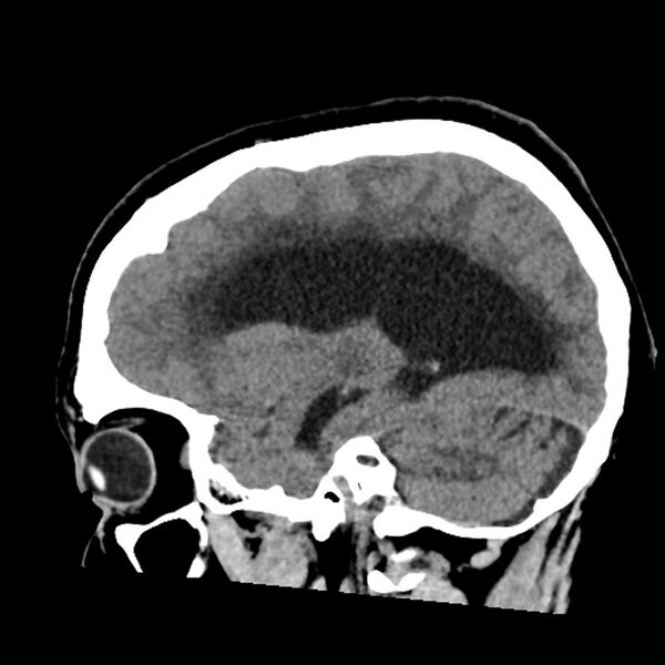 File:Chiasmatic-hypothalamic juvenile pilocytic astrocytoma (Radiopaedia 78533-91237 B 23).jpg