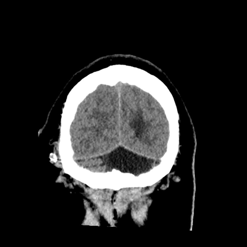 Chiasmatic-hypothalamic juvenile pilocytic astrocytoma (Radiopaedia 78533-91237 Coronal non-contrast 62).jpg