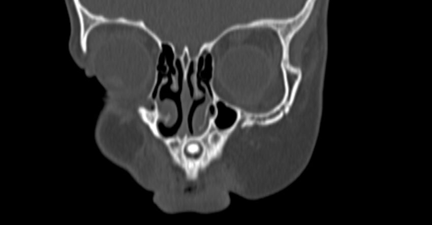 Choanal atresia (Radiopaedia 51295-56972 Coronal bone window 3).jpg