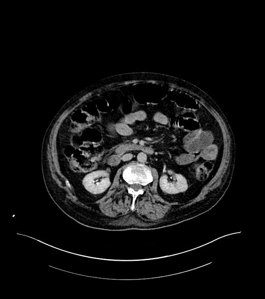 File:Cholangiocarcinoma with cerebral metastases (Radiopaedia 83519-98629 Axial C+ delayed 53).jpg