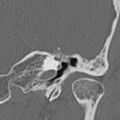 Cholesteatoma (Radiopaedia 9408-10093 Coronal bone window 11).jpg