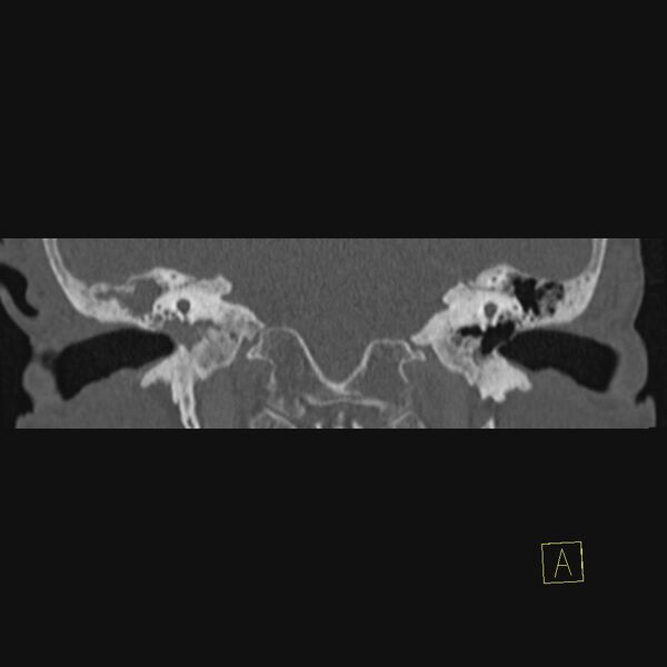 File:Cholesteatomatous chronic otitis (Radiopaedia 14993-14911 Coronal bone window 6).JPEG